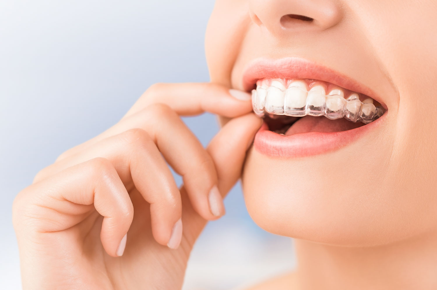 https://www.drsarasyed.com/wp-content/uploads/2019/01/invisalign.jpg